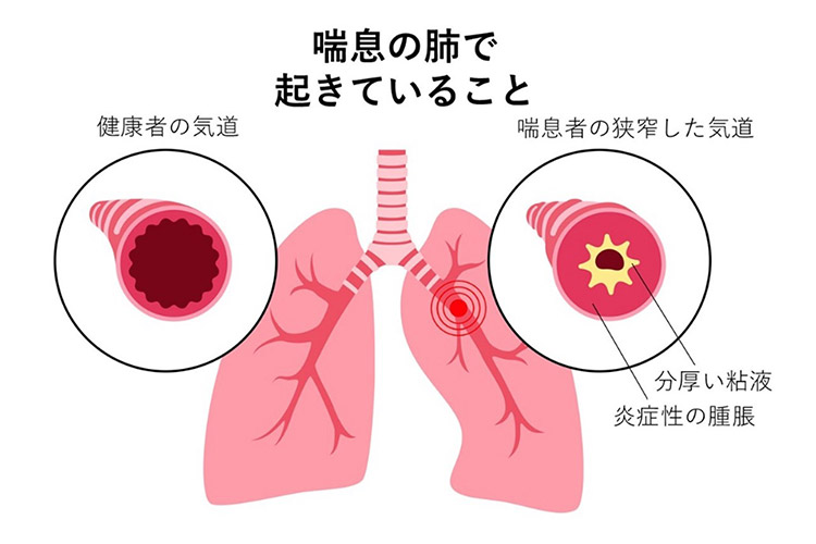 喘息の肺で起きていること